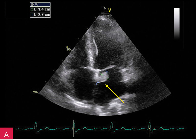 Rycina 10A, B. Wybrane patologie, które należy uwzględnić w diagnostyce serowatego zwapnienia pierścienia mitralnego (CCMA):  śluzak w lewym przedsionku (A), wegetacja zastawki mitralnej (B)