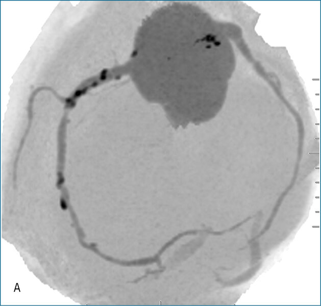 Rycina 2. Badanie tętnic wieńcowych metodą tomografii komputerowej. A. Rekonstrukcja MIP Inwers (maksimum intensity projection) – widoczne wielopoziomowe zmiany w prawej tętnicy wieńcowej. B. Warstwa poprzeczna (axial) – obraz remodelingu dodatniego ściany naczynia w segmencie 3 prawej tętnicy wieńcowej; blaszka niskiej gęstości zwęża światło w 40%, jednak jej faktyczna wielkość ukryta jest dzięki modelowaniu ściany naczynia na zewnątrz. 