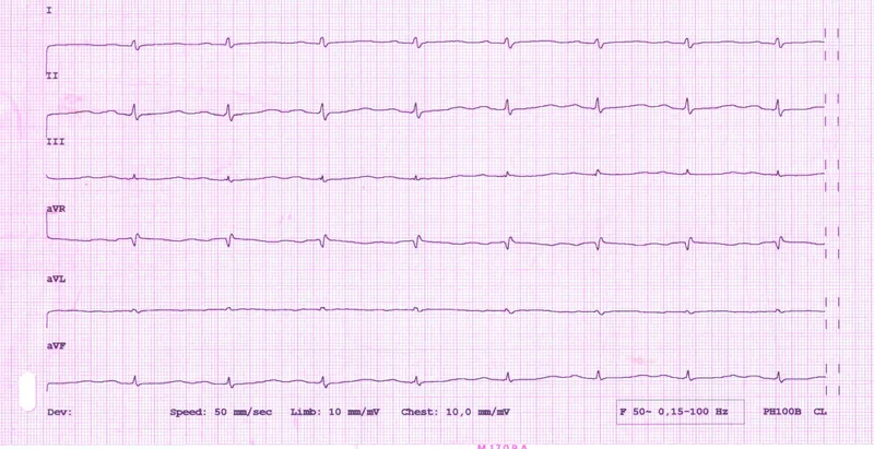 Rycina 2. EKG z niskim woltażem (<0,5 mV) załamków QRS w odprowadzeniach kończynowych – obraz, który może sugerować płyn w jamie osierdzia.