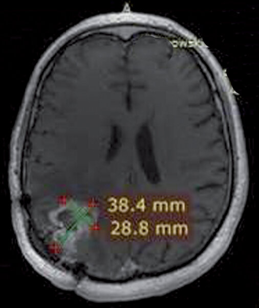 3. Badanie MRI 6 tygodni po drugim podaniu 213Bi-SP.