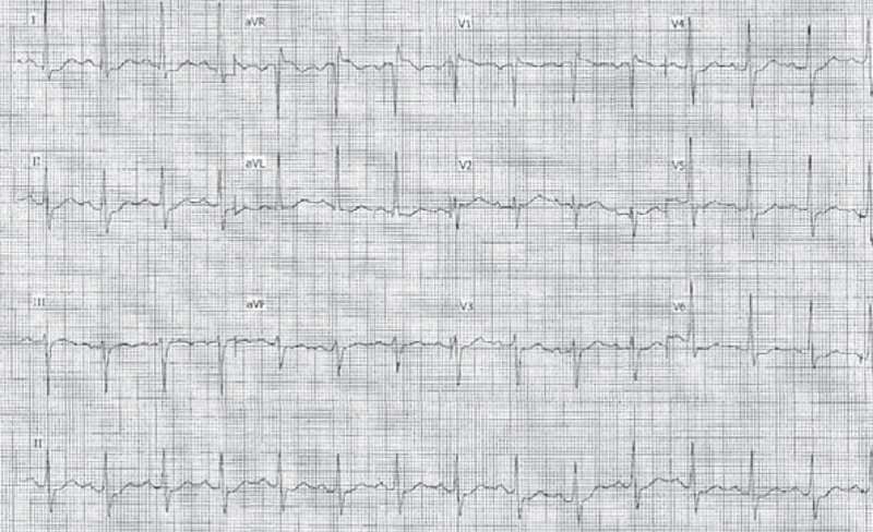 Rycina. Elektrokardiogram przy przyjęciu do szpitala