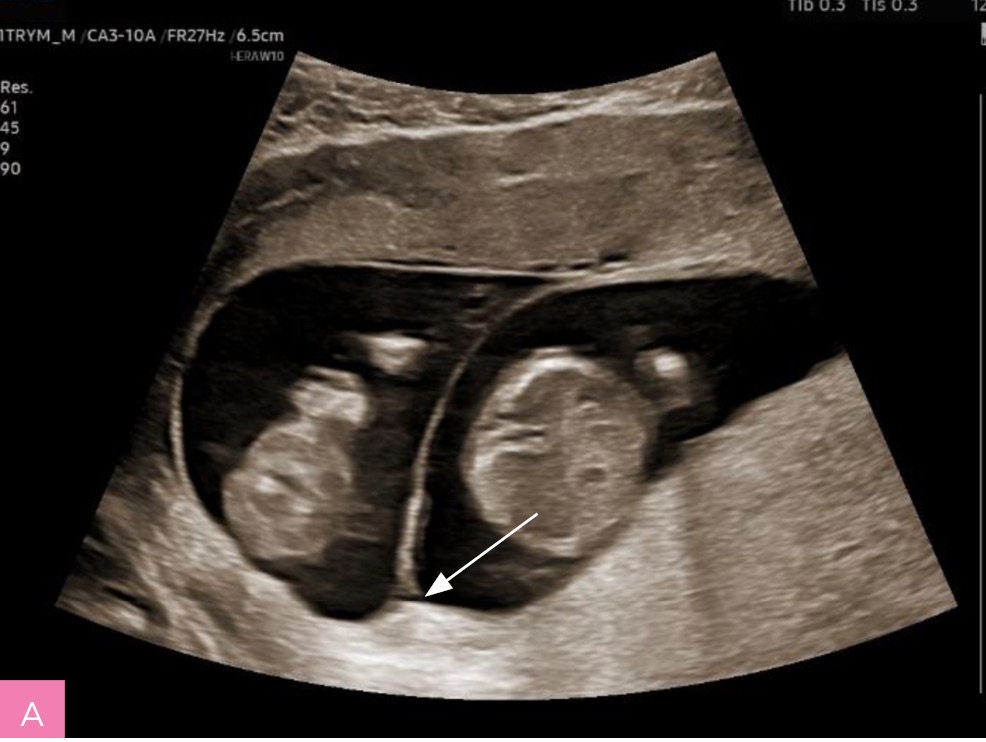 Rycina 1A, B. Badanie ultrasonograficzne wykonane w I trymestrze ciąży. A. Ciąża bliźniacza dwukosmówkowa dwuowodniowa, płody są oddzielone grubą warstwą 2 błon kosmówki i 2 błon owodni (objaw λ). B. Ciąża bliźniacza jednokosmówkowa dwuowodniowa, płody są oddzielone tylko 2 cienkimi warstwami owodniowymi (objaw τ)