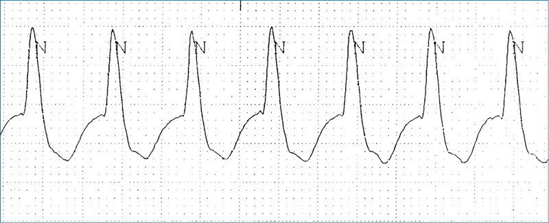 
 
 Rycina 2. Fragment zapisu EKG z monitora w dużym powiększeniu. Widoczne szerokie zespoły QRS, częstość akcji serca 148/min