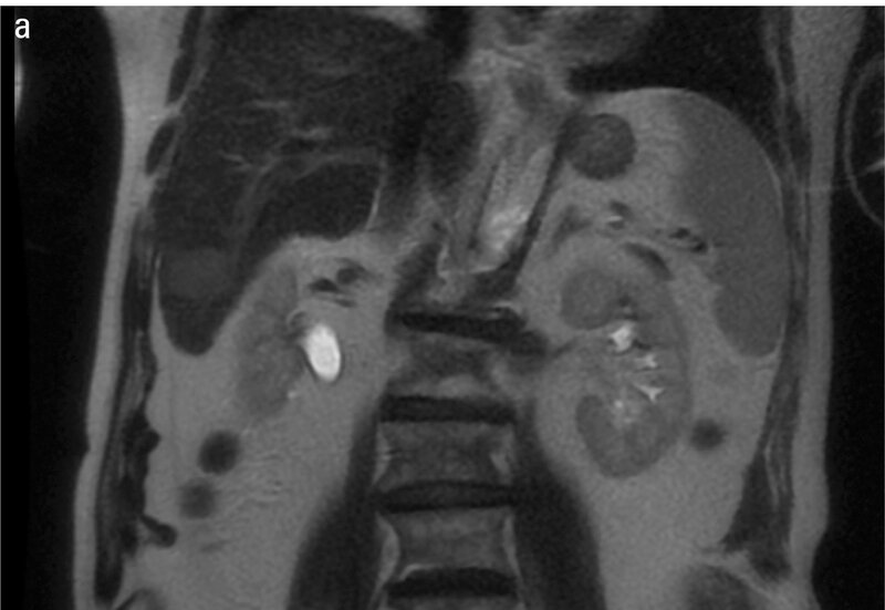 
 
 Fot. 2 Obraz MR przed leczeniem. (a) W projekcji osiowej widoczna zmiana w segmencie 6. (b) Na przekroju poprzecznym w segmencie 4 widoczna zmiana  w okolicy pęcherzyka żółciowego.