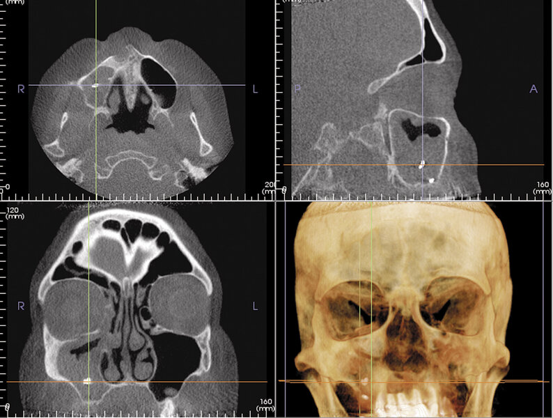 Ryc. 1. Zmiany radiologiczne w zatoce szczękowej.
