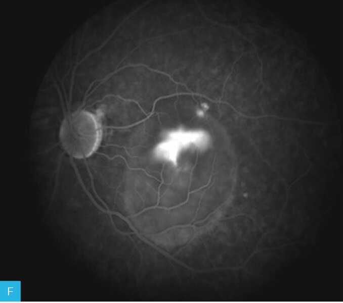Rycina 13A-F. Angiogram oka lewego