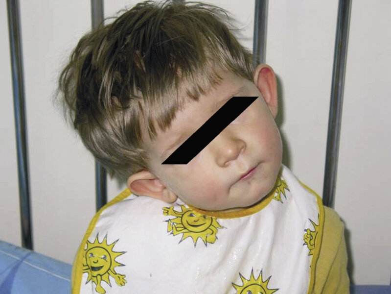 Rycina 2. Kręcz szyi u dziecka z guzem pnia mózgu.