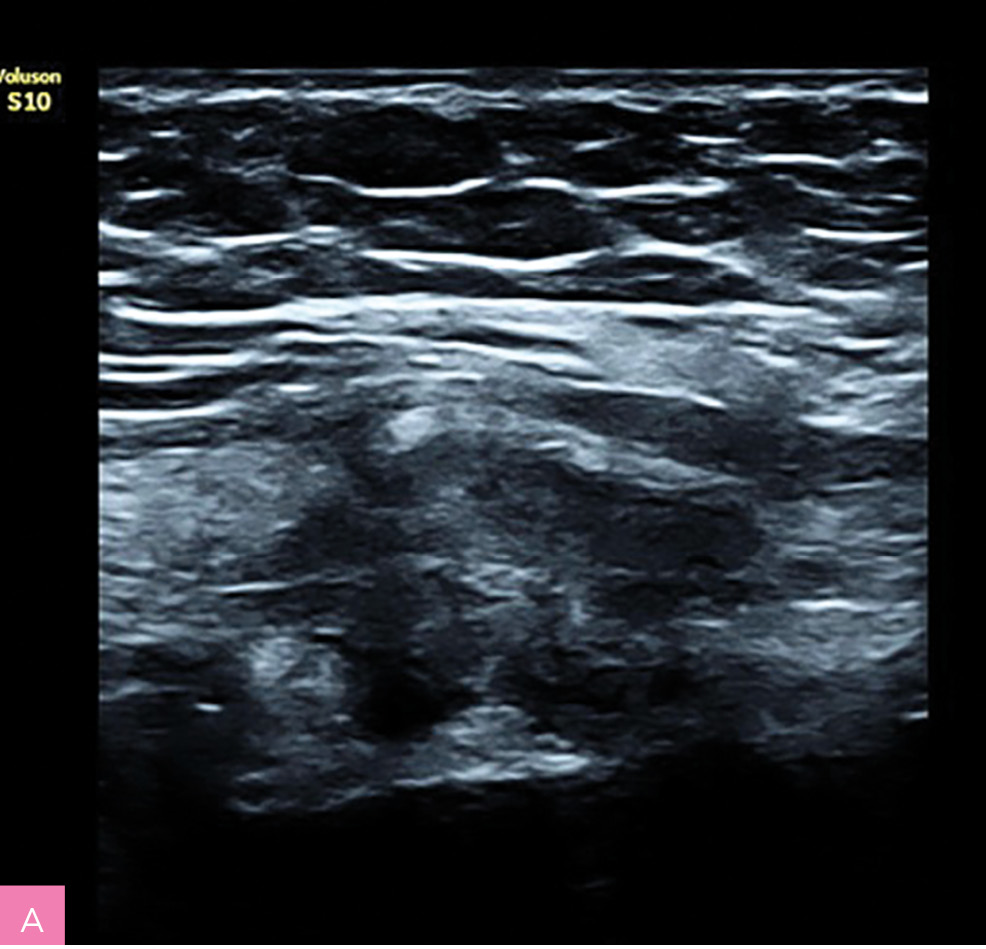 Rycina 1A, B. Obraz ultrasonograficzny zmiany endometrialnej powłok brzucha z typowymi spikularnymi brzegami  (materiał własny autorki)