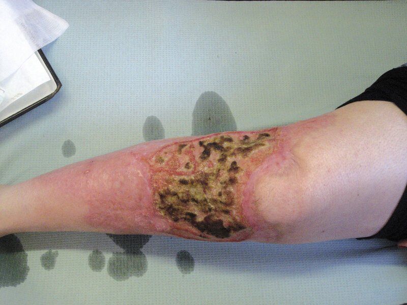 Ryc. 6. Masywne, częściowo wygojone, z blizną na obwodzie, owrzodzenie w przebiegu pyoderma gangrenosum.