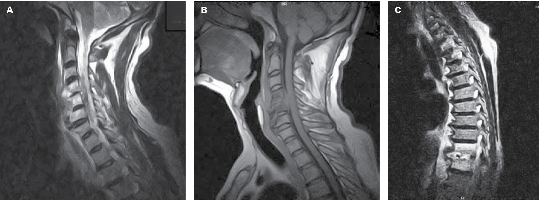 Rycina 1. (A, B) Zmiany o typie spondylodiscitis obejmujące trzony kręgów i przestrzenie międzykręgowe C4-C5, C5-C6 oraz towarzyszący ropień przykręgosłupowy na wysokości C4-C5. (C) Spondylodiscitis na wysokości Th11-Th12.