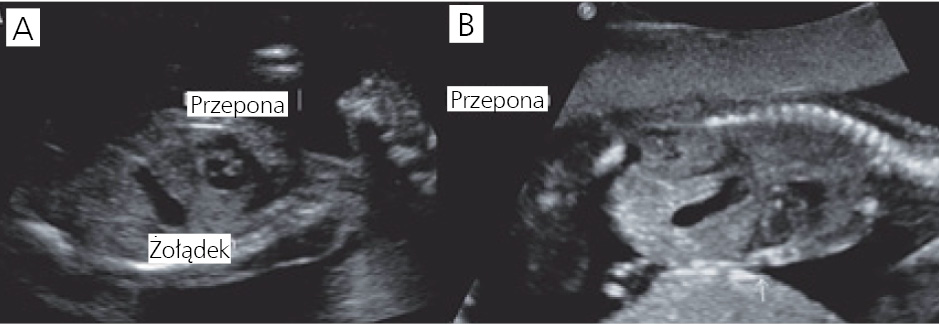 Rycina 3. Dwa przekroje poprzeczne.