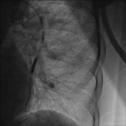 Ryc. 2. Przeskórna angioplastyka balonowa w tętnicy dolnopłatowej lewej (na zdjęciu widoczny cewnik balonowy).
