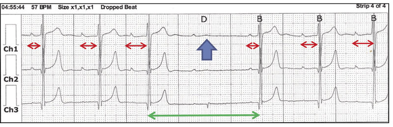 Rycina 3. Zapis holterowski EKG (3-kanałowy, Ch1 – zmodyfikowane komputerowo odprowadzenie przedsercowe V5, Ch2 – zmodyfikowane komputerowo odprowadzenie przedsercowe V1) u pacjenta z ryciny 2. W godzinach nocnych epizod bloku przedsionkowo-komorowego II stopnia typu periodyki Wenckebacha: stopniowe wydłużanie się odstępu PR (czerwone poziome strzałki) do wypadnięcia pobudzenia komór (D – dropped beat; po załamku P nie ma zespołu QRS) z pauzą R-R 2100 ms (zielona strzałka pozioma). Przesuw papieru 25 mm/s.