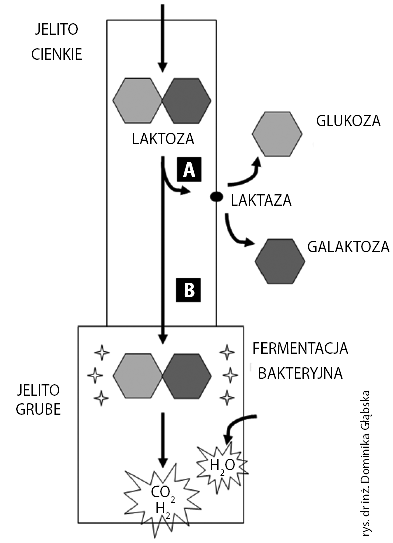 Ryc. 1. Schemat prawidłowego rozkładu laktozy przez laktazę w jelicie (A) i obrazu w nietolerancji laktozy (B).