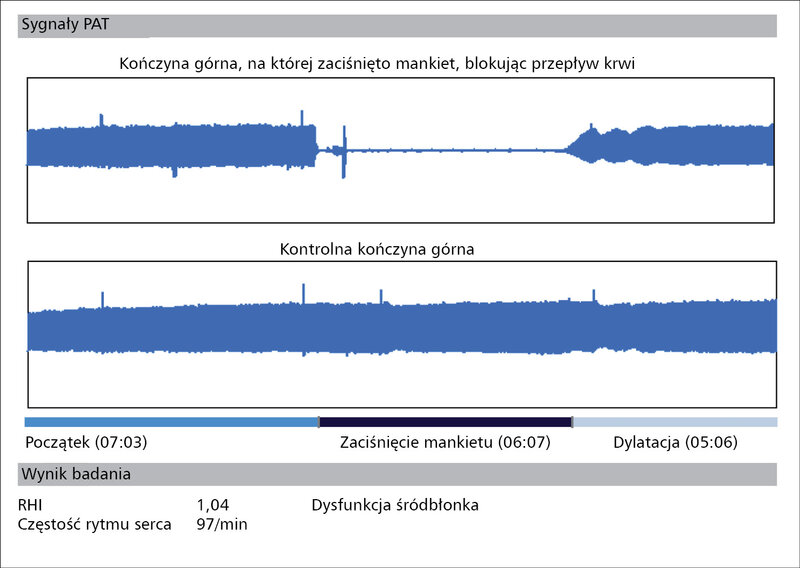 Rycina 2. Wynik badania RH-PAT (reactive hyperemia – peripheral arterial tonometry; reaktywne przekrwienie – obwodowa tonometria tętnicza). RHI (reactive hyperemia index) – wskaźnik reaktywnego przekrwienia.