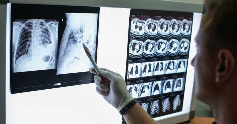 Sekwencjonowanie nowej generacji musi być standardem w diagnostyce raka płuca