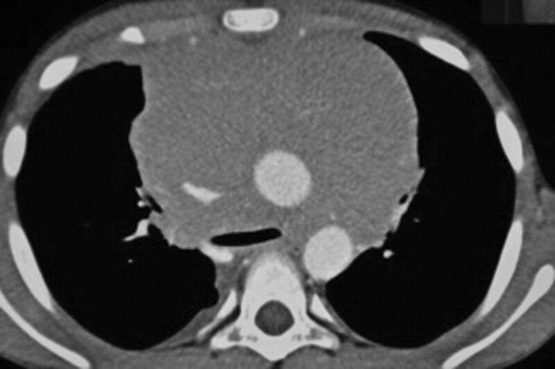 Rycina 3. Olbrzymi guz śródpiersia (bulky tumor) u dziecka z zespołem żyły głównej górnej