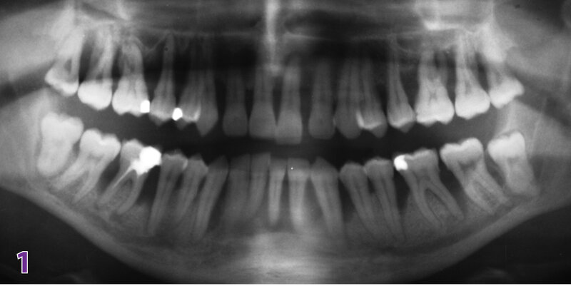 Ryc. 1. Zdjęcie ortopantomograficzne – przed leczeniem (styczeń 2005 roku).
