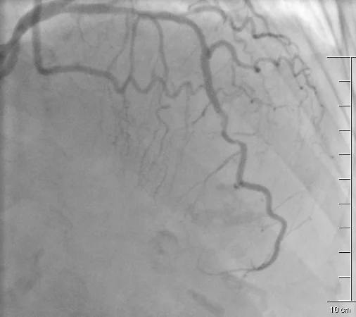 Rycina 3. Ostateczny rezultat angioplastyki gałęzi przedniej zstępującej.