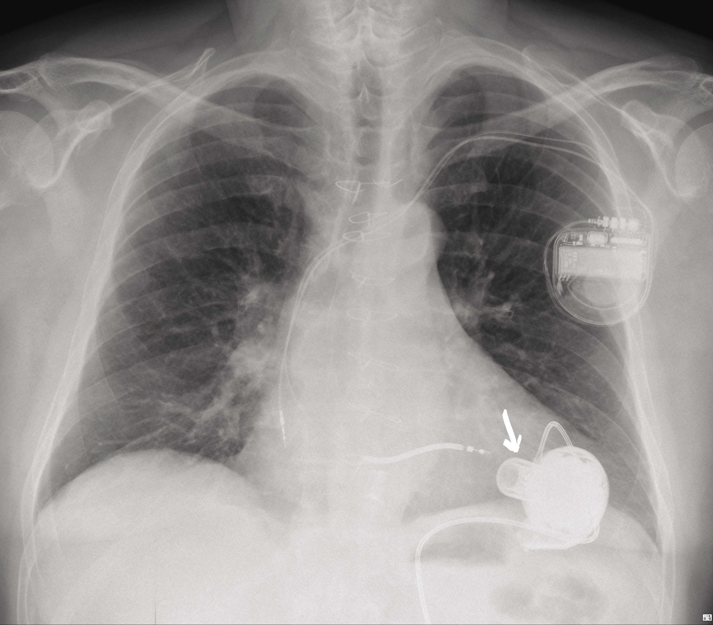 Rycina 3. Zdjęcie RTG P-A chorego z implantowanym systemem HeartWare™ (metalowa kaniula doprowadzająca w koniuszku lewej komory oznaczona strzałką)