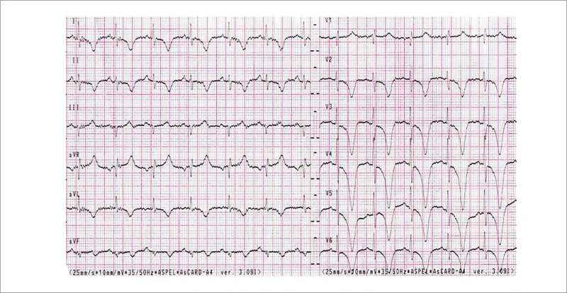 Rycina 4. EKG 78-letniej pacjentki z wywiadem stresu poprzedzającego hospitalizację, z podwyższonym stężeniem troponiny, z akinezą koniuszka w badaniu echokardiograficznym, z prawidłowym obrazem angiograficznym naczyń wieńcowych. Uwagę zwracają rozlane, bardzo głębokie ujemne załamki T w odprowadzeniach I, II, aVL, aVF i V2-V6 z uniesieniem odcinka ST w odprowadzeniu aVR i dodatnim załamkiem T w odprowadzeniach aVR i V1.