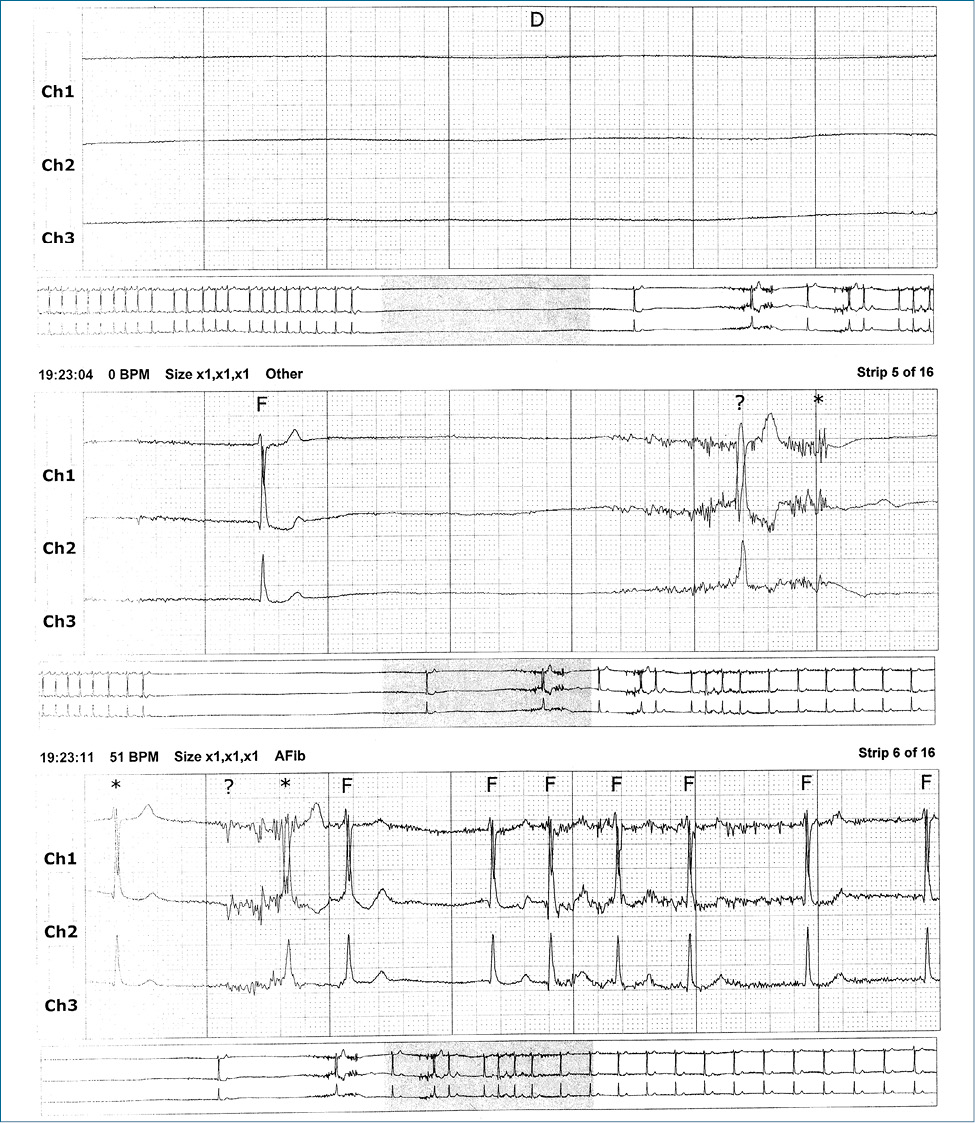 Rycina 1. Fragment zapisu EKG rejestracji całodobowej przedstawia pauzę o długości kilkunastu sekund, po której następuje wstawka epizodu migotania przedsionków i powrót rytmu zatokowego