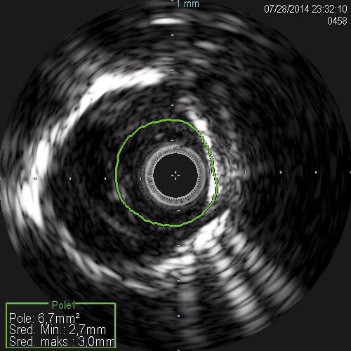 Ryc. 3. Obraz ultrasonograficzny przepony i zwężenia poddanego przezskórnej angioplastyce balonowej.