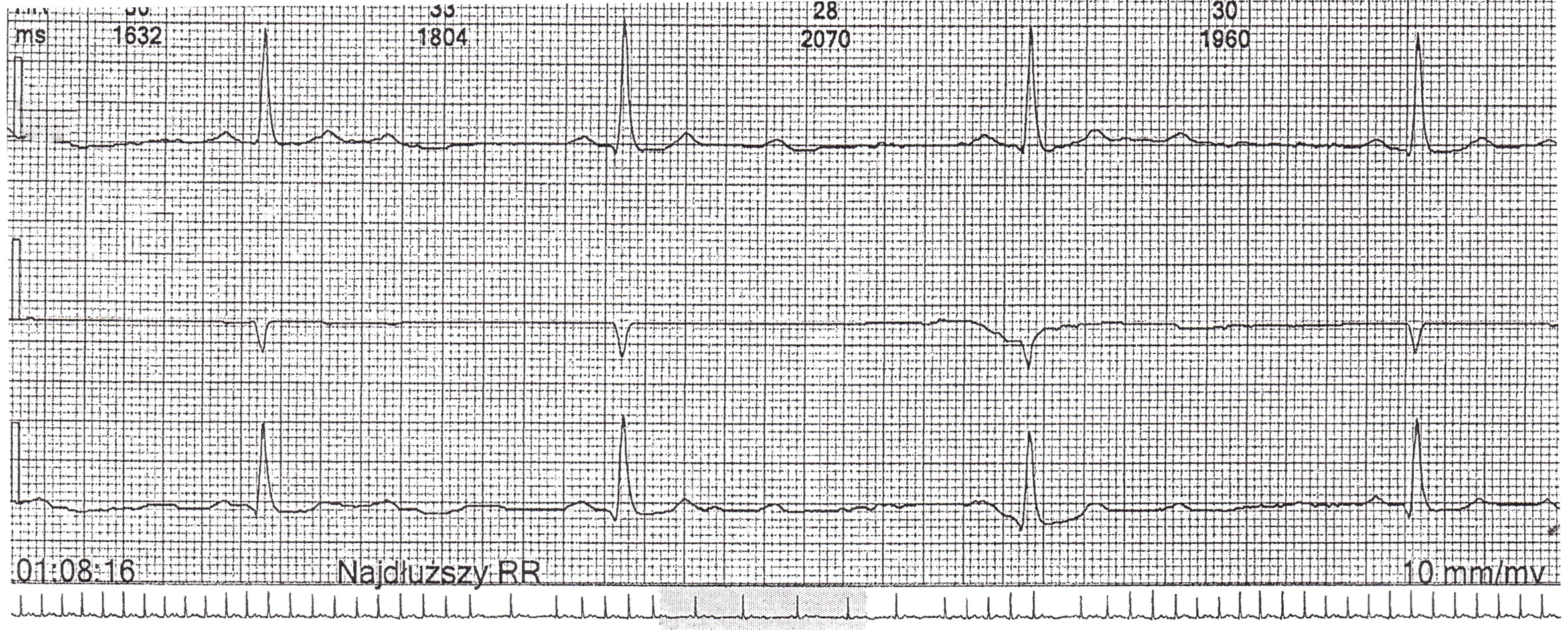 Rycina 2. Fragment zapisu z badania EKG metodą Holtera. Epizody bloku przedsionkowo-komorowego II° typu Mobitz II rejestrowane jedynie podczas snu u pacjenta z ciężkim obturacyjnym bezdechem sennym