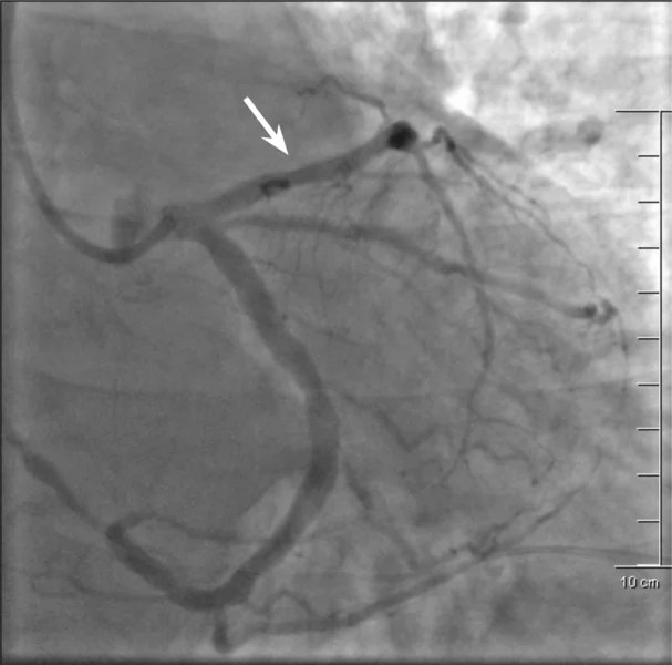 Rycina 4. Angiogram lewej tętnicy wieńcowej po skutecznej angioplastyce gałęzi przedniej zstępującej (strzałka).