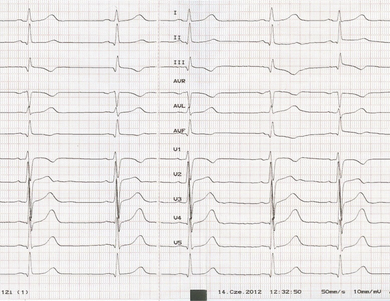 Rycina 8. EKG dziecka 9-letniego.