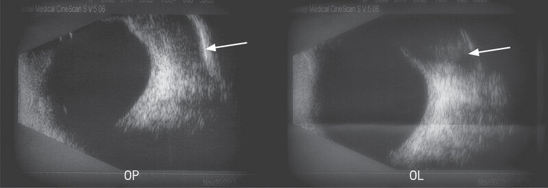 
 
 Rycina 3. Badanie ultrasonograficzne oczodołów – powiększenie gruczołów łzowych (strzałki)