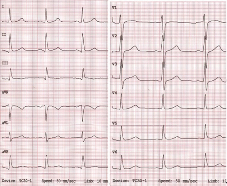 Rycina 11. EKG siedemnastolatka.