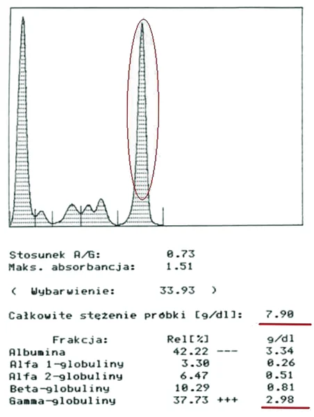 Ryc. 2. Typowy proteinogram w gammapatii monoklonalnej.