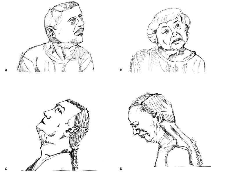Rycina 1. Dystonia szyjna – najczęściej spotykane wzorce kręczu karku.