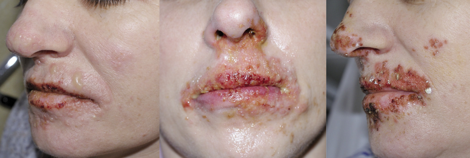 Rycina 1. Herpes labialis. Reaktywacja HSV wzdłuż gałązki 3 nerwu V. Zmiany w kolejnych dniach.
