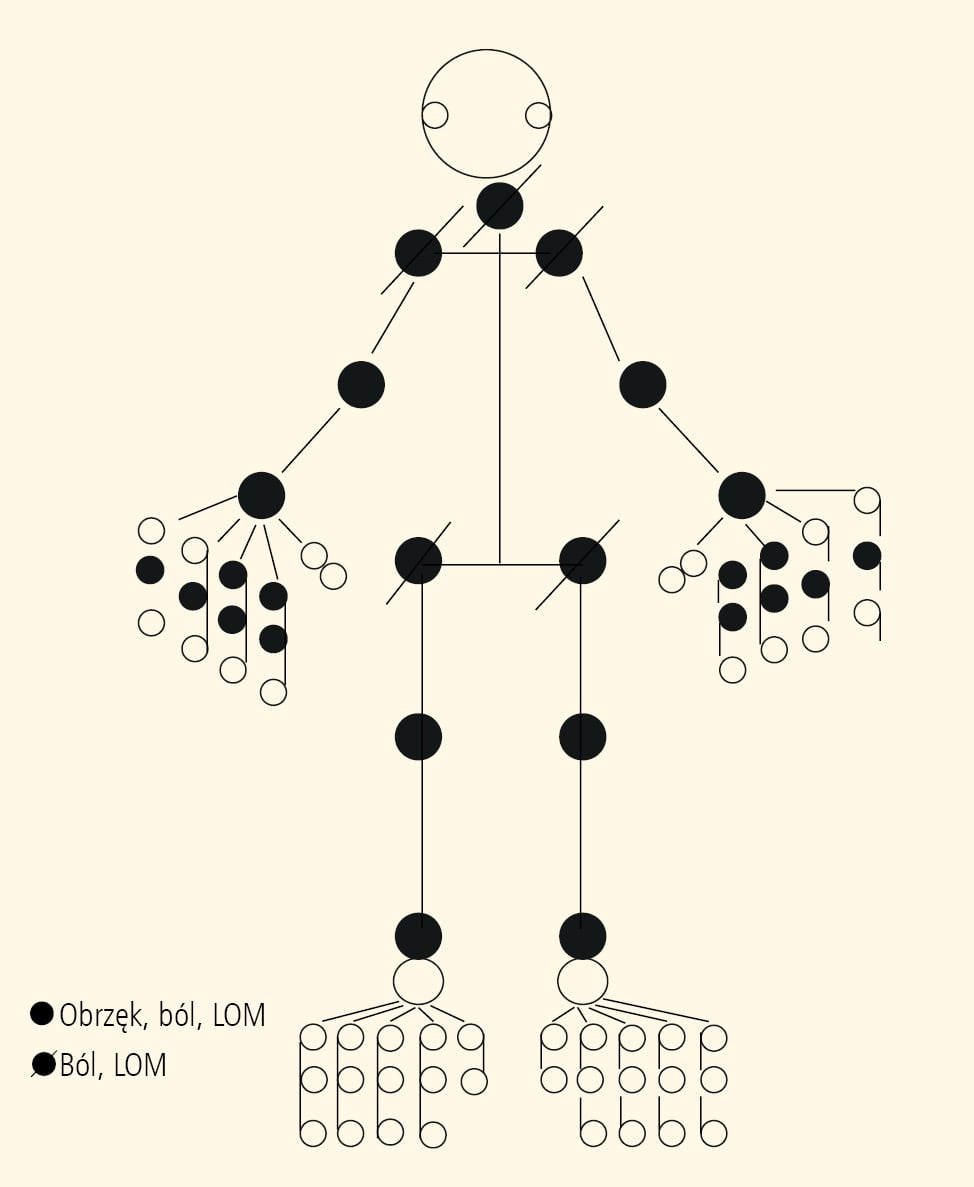 Rycina 1. Diagram z liczbą zajętych stawów w wielostawowym MIZS. LOM – obrzęk, ból, ograniczenie ruchomości