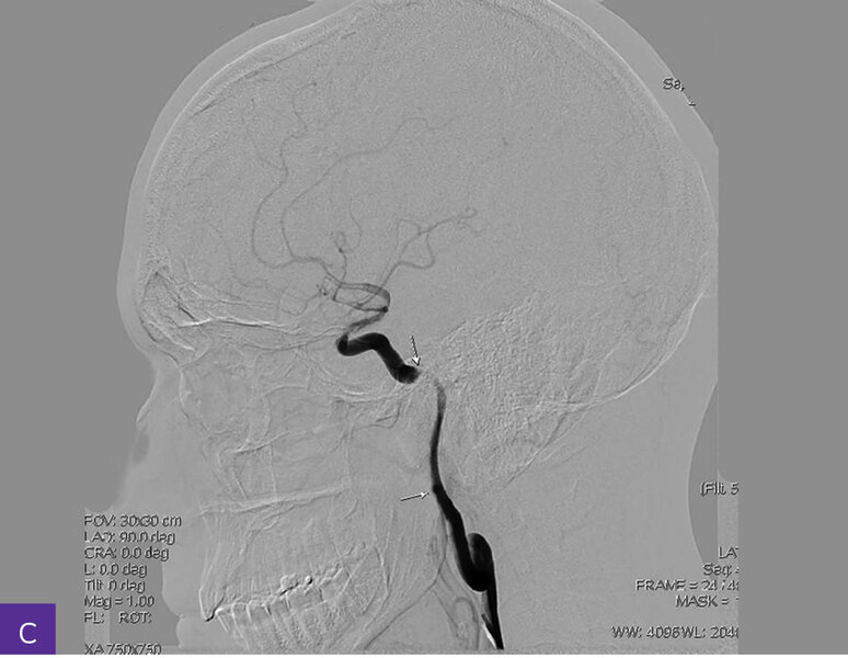 Rycina 4A-C. Cyfrowa angiografia subtrakcyjna (DSA). Widoczna przewlekła niedrożność nadklinowych odcinków obu tętnic szyjnych wewnętrznych, z wzorcem unaczynienia końcowego typu moyamoya, niedrożnością odcinków M1 obu tętnic środkowych mózgu, hipoplazją odcinków A1 obu tętnic przednich mózgu i krążeniem obocznym