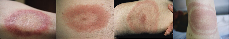 Rycina 1. Rumień wędrujący (erythema migrans, EM).