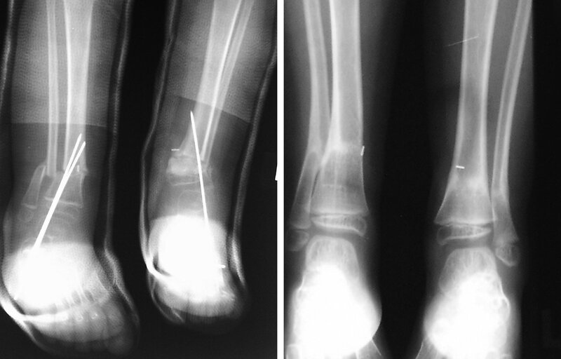 Ryc. 4, 5. Zdjęcia radiologiczne miesiąc po replantacji i trzy lata po replantacji.