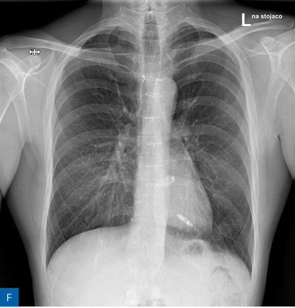 Rycina 1. Obraz radiologiczny w procesie identyfikacji kardiologicznego urządzenia wszczepialnego (CIED). A. Rozrusznik dwujamowy. B. Kardiowerter-defibrylator dwujamowy. C. Kardiowerter-defibrylator podskórny. D. Urządzenie do terapii resynchronizującej z funkcją defibrylacji E. Pętlowy rejestrator zdarzeń oraz rozrusznik dwujamowy. F. Stymulator bezelektrodowy typu Micra. G. Stymulator bezelektrodowy Abbott AVEIR. H. Układ poprawiający kurczliwość mięśnia sercowego (strona prawa) oraz kardiowerter-defibrylator jednojamowy (strona lewa)