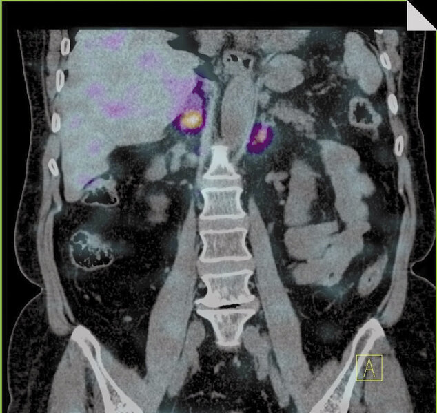 Ryc. 4. Badanie SPECT-CT po podaniu 131I-MIBG. Badanie scyntygraficzne w diagnostyce guza chromochłonnego nadnerczy.