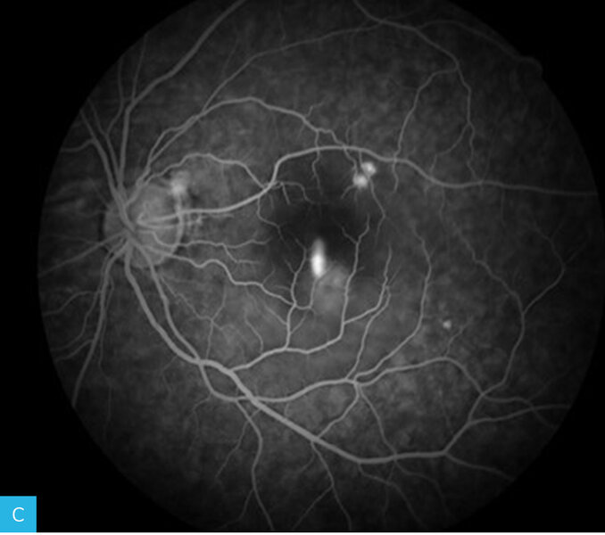Rycina 13A-F. Angiogram oka lewego