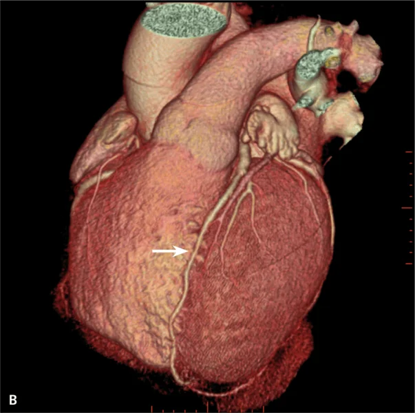 RYCINA 2. [A] Rekonstrukcja MIP Inversion. Obraz tętnic wieńcowych z drobnym mostkiem mięśniowym w segmencie 8 (strzałka). [B] Rekonstrukcja VR (volume rendering) – obraz prawidłowych tętnic wieńcowych. Mostek mięśniowy zaznaczony strzałką.