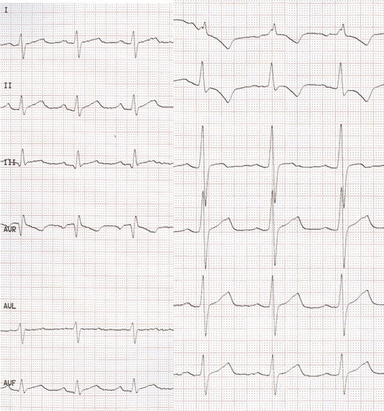 Rycina 5. EKG 10-miesięcznego niemowlęcia.