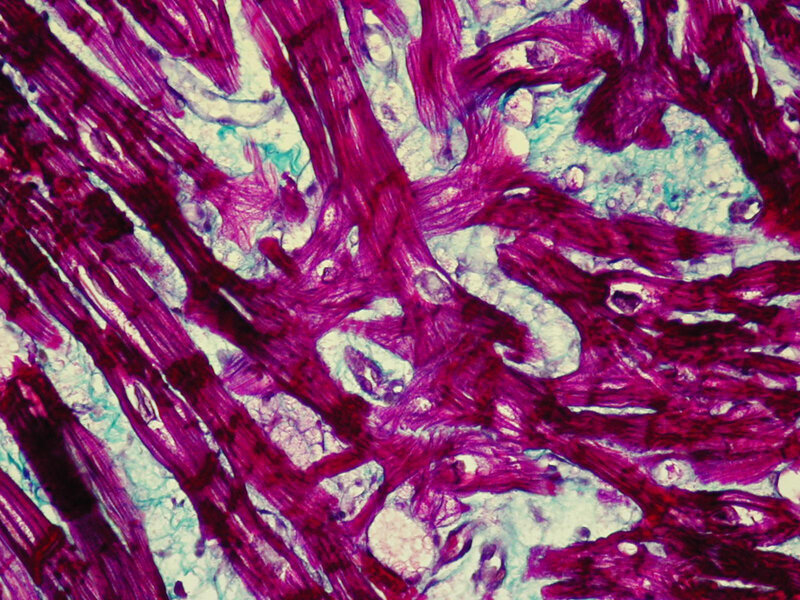Rycina 6. Biopsja endomiokardialna. Kardiomiopatia przerostowa. Chaotyczny przebieg włókien mięśniowych (czerwony kolor) w reakcji histochemicznej metodą trójbarwną Massona (włókna kolagenowe zabarwione na kolor zielony)