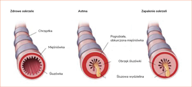 Rycina 1. Mechanizm powstawania obturacji w astmie i zapaleniu oskrzeli