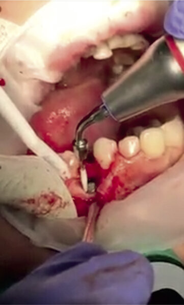 Rycina 5. Oczyszczanie implantu – końcówka skalera PI