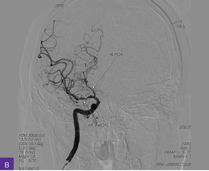 Rycina 4A-C. Cyfrowa angiografia subtrakcyjna (DSA). Widoczna przewlekła niedrożność nadklinowych odcinków obu tętnic szyjnych wewnętrznych, z wzorcem unaczynienia końcowego typu moyamoya, niedrożnością odcinków M1 obu tętnic środkowych mózgu, hipoplazją odcinków A1 obu tętnic przednich mózgu i krążeniem obocznym
