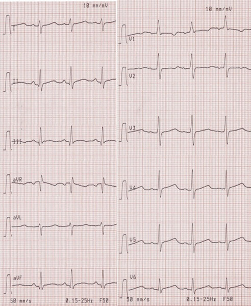 Rycina 4. EKG noworodka.