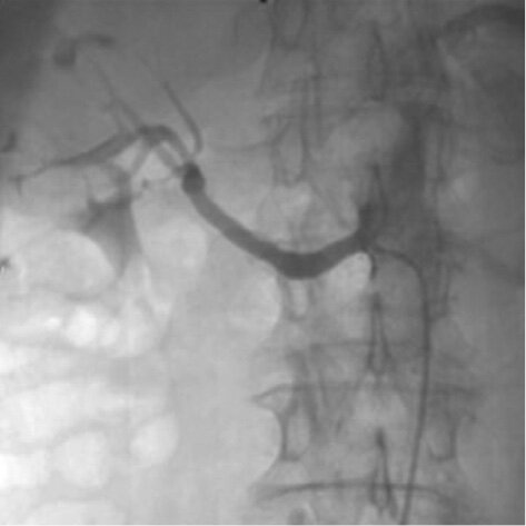 Rycina. Angiogramy nerki. Po stronie lewej – ciężkie zwężenie ujścia prawej tętnicy nerkowej. Po stronie prawej – stan po przezskórnej angioplastyce z implantacją stentu w prawej tętnicy nerkowej.